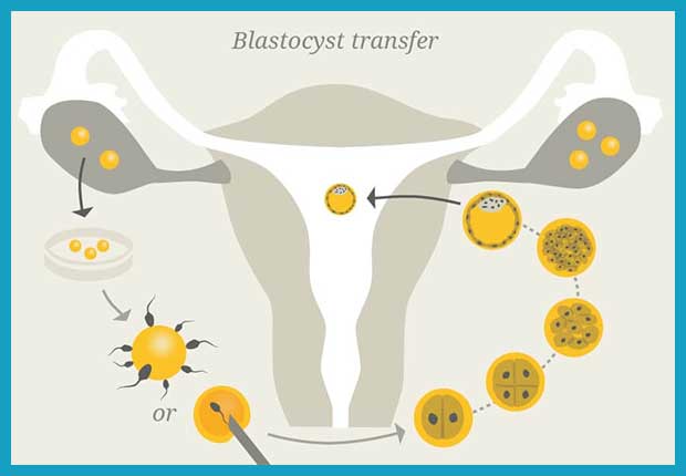 blastocyst transfer